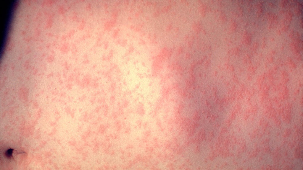 25 cases of measles identified in central, southeastern Minnesota, MDH says — WCCO / CBS Minnesota, Naples Health news