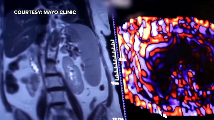 Healthy SA: Battling liver cancer, a disease which often has no symptoms early on — KENS 5 (San Antonio), Naples Health news